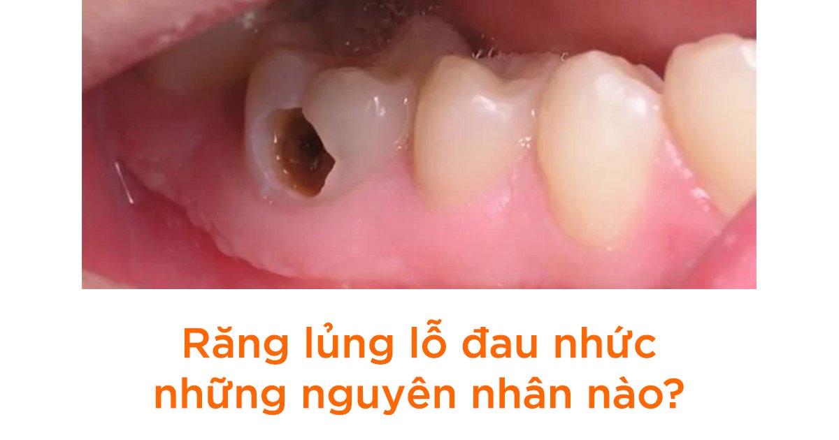 Răng lủng lỗ đau nhức những nguyên nhân nào?