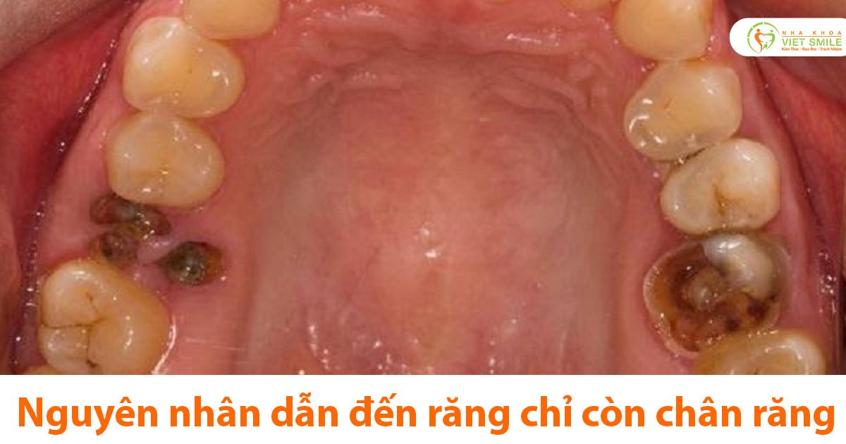 Nguyên nhân dẫn đến răng chỉ còn chân răng