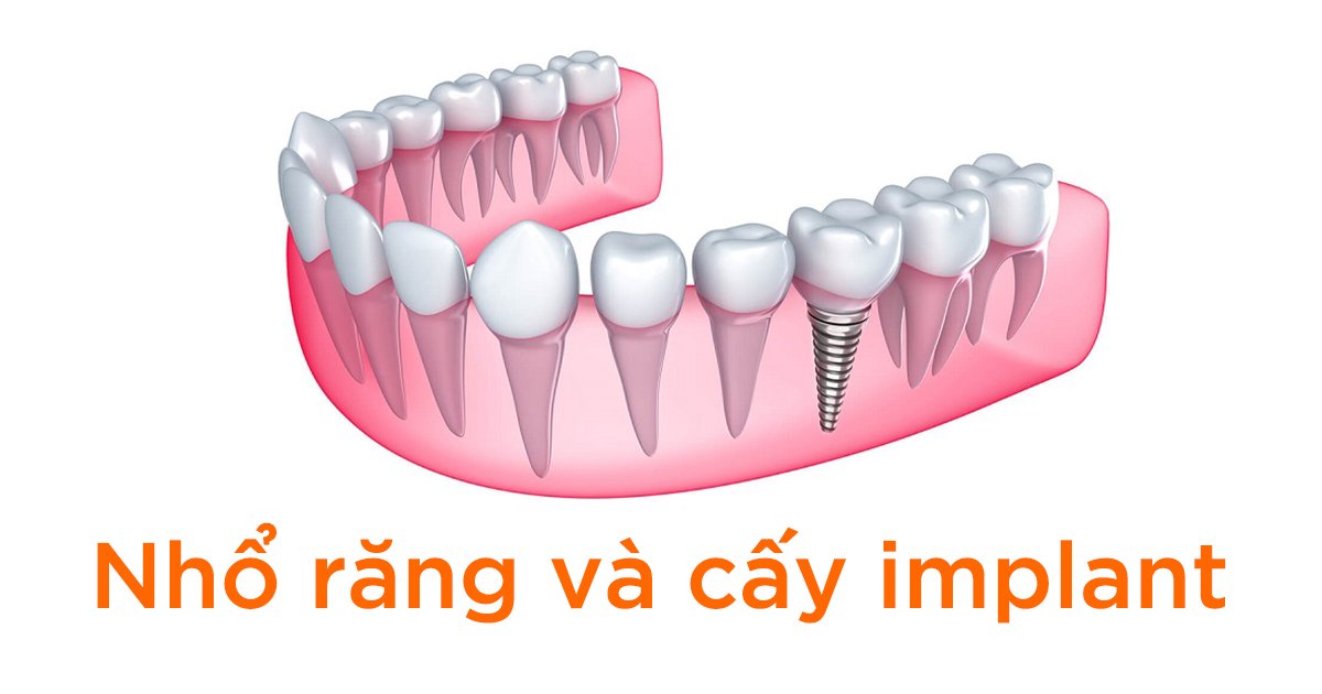 Nhổ răng và cấy implant