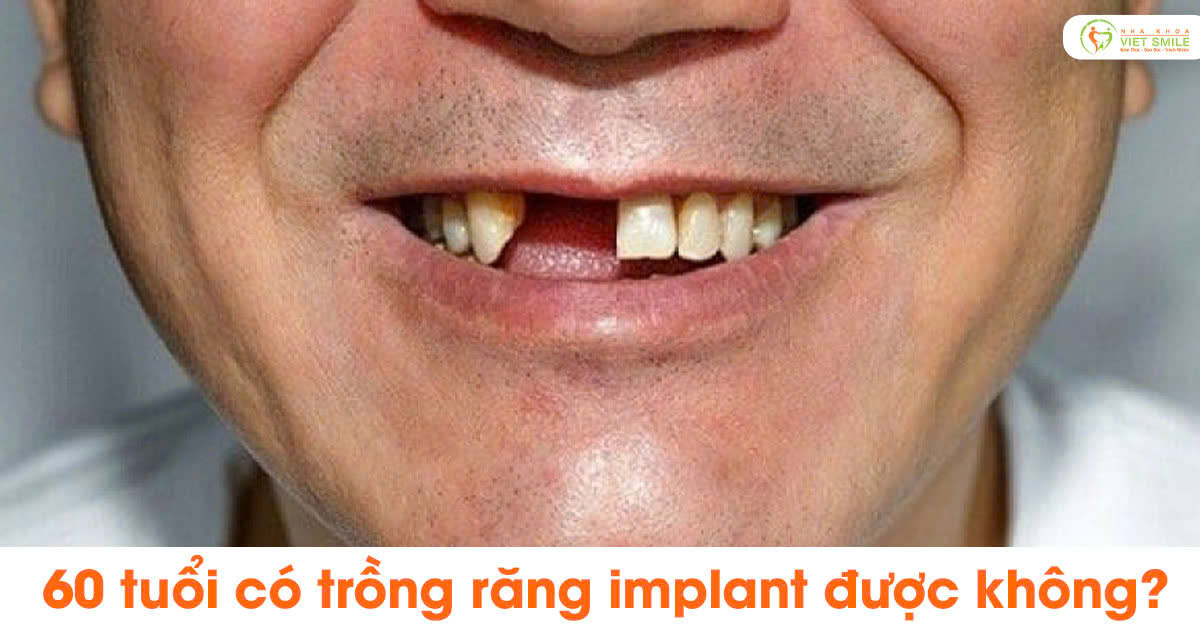 60 tuổi có trồng răng implant được không?