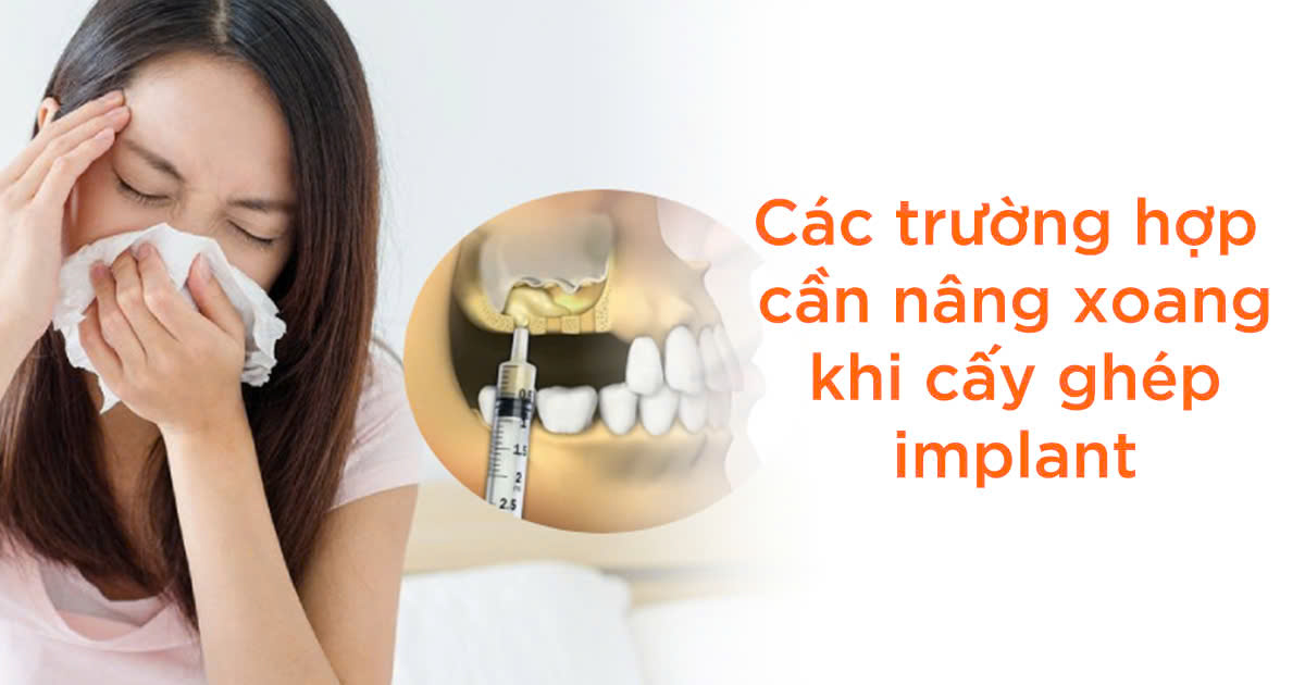 Các trường hợp cần nâng xoang khi cấy ghép implant