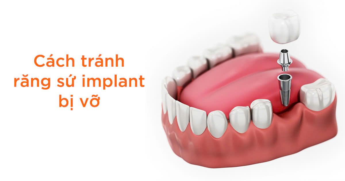 Cách tránh răng sứ implant bị vỡ