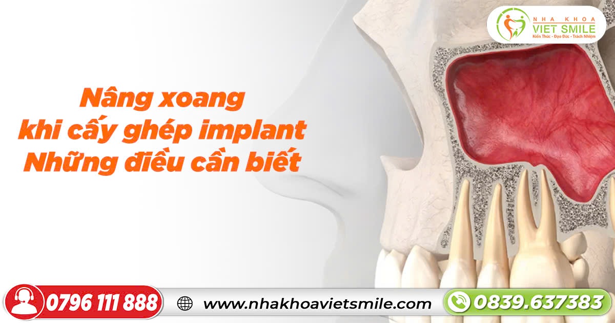 Nâng xoang khi cấy ghép implant- những điều cần biết