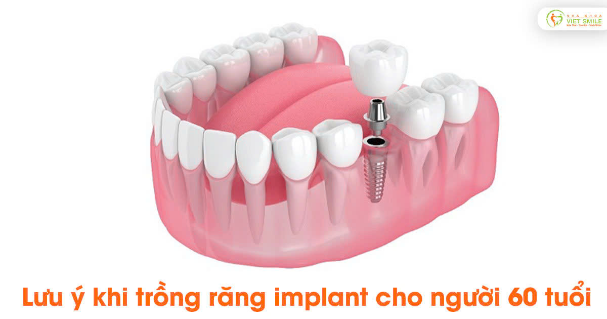 Lưu ý khi trồng răng implant cho người 60 tuổi