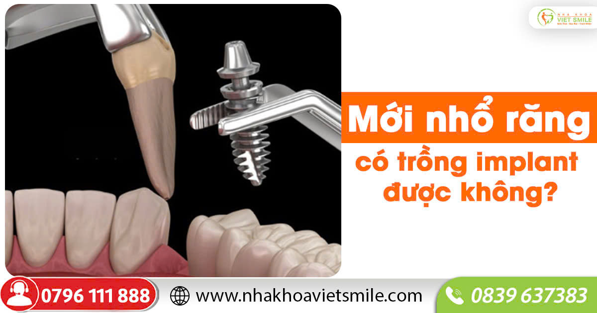 Mới nhổ răng có trồng implant được không?