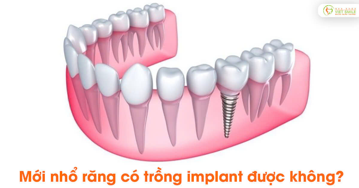 Mới nhổ răng có trồng implant được không?