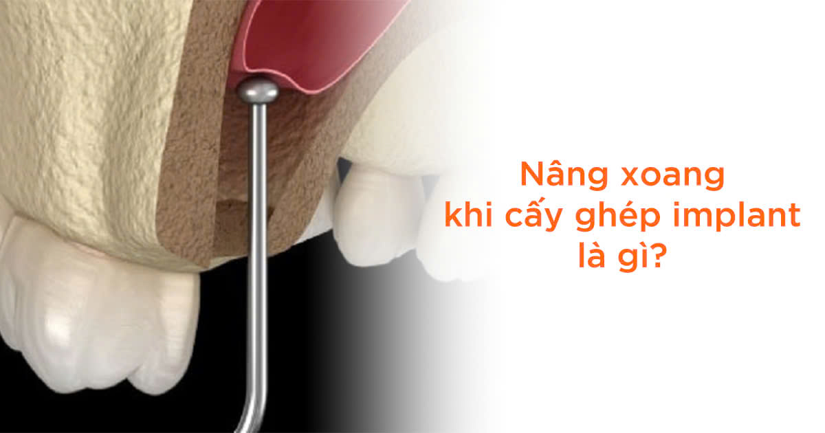 Nâng xoang khi cấy ghép implant là gì?