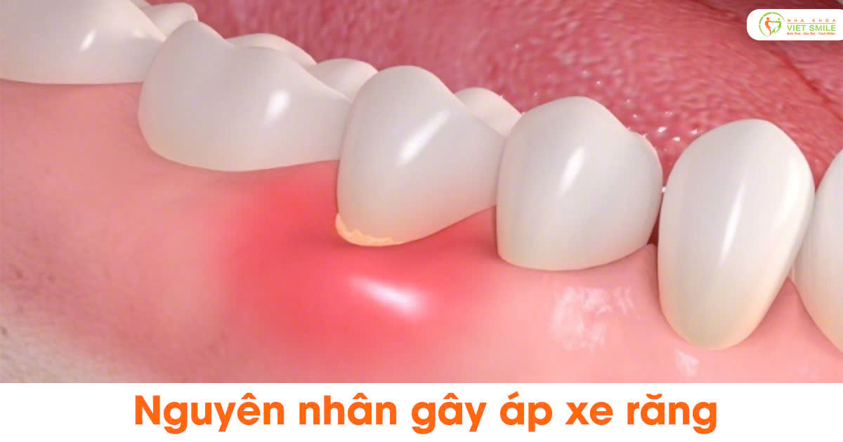 Nguyên nhân gây áp xe răng