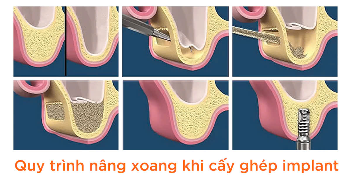 Quy trình niềng xoang khi cấy ghép implant