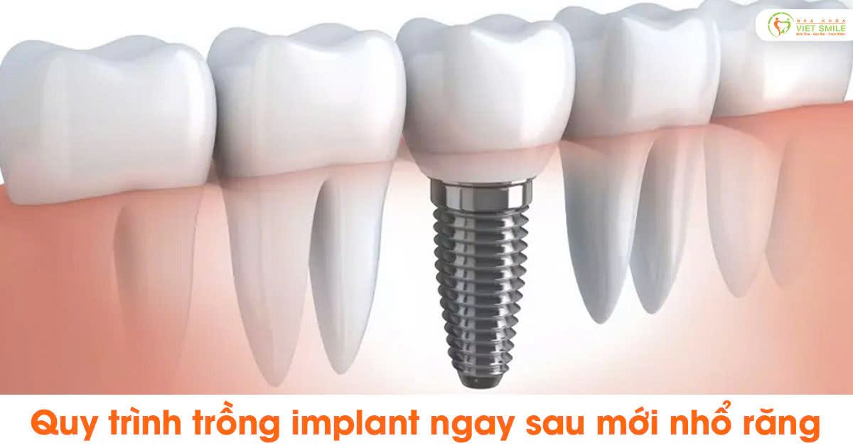 Quy trình trồng implant ngay sau mới nhổ răng