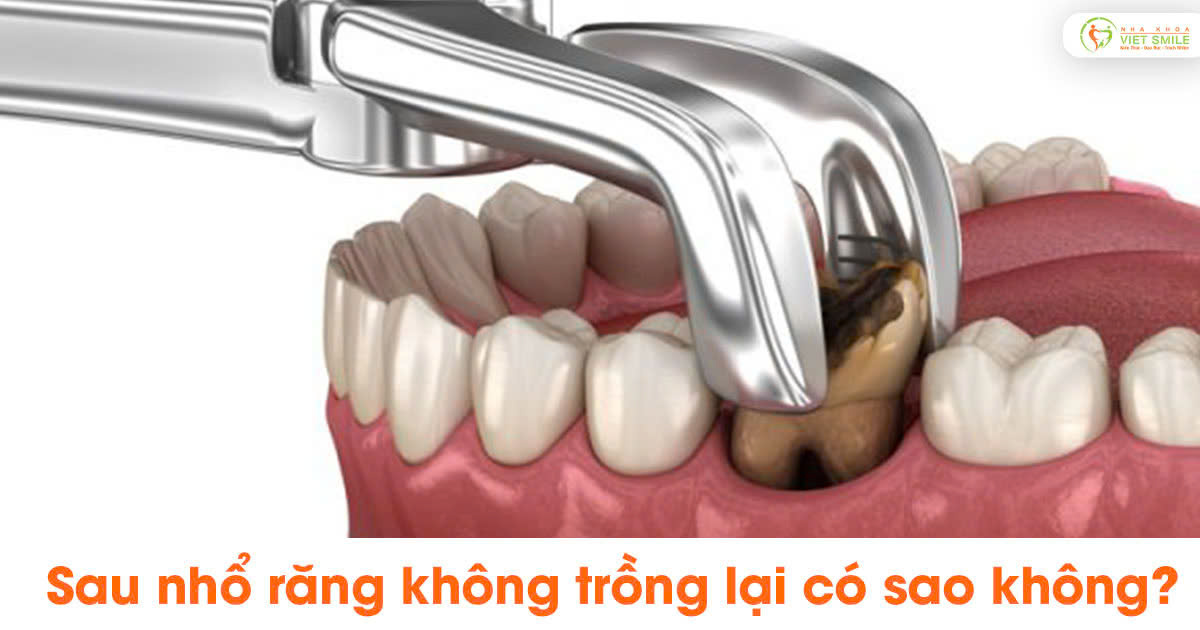 Sau nhổ răng không trồng lại có sao không?