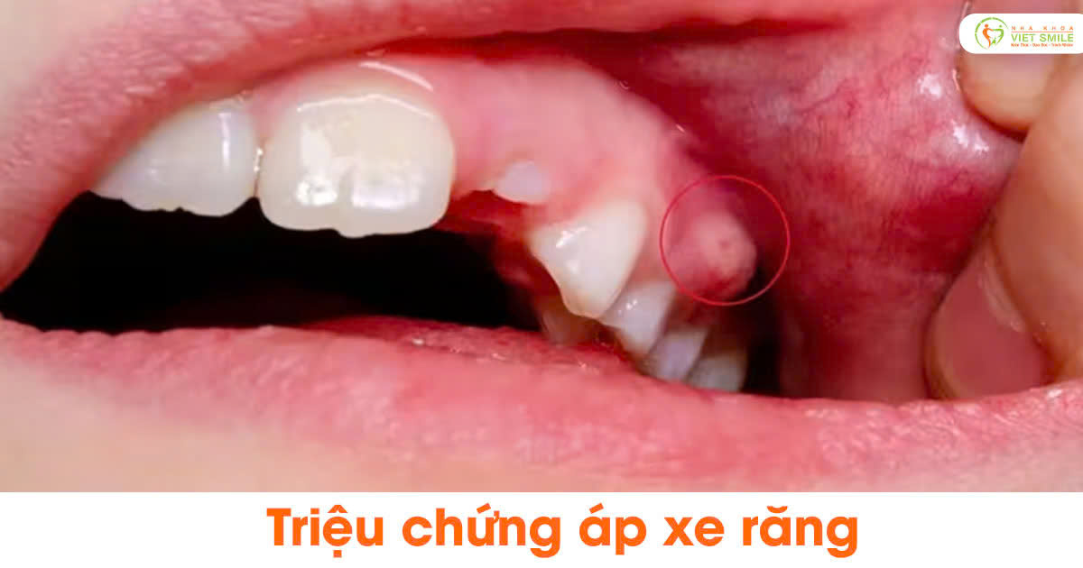 Triệu chứng áp xe răng