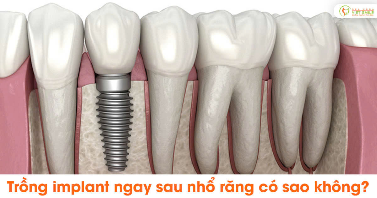 Trồng implant ngay sau nhổ răng có sao không?