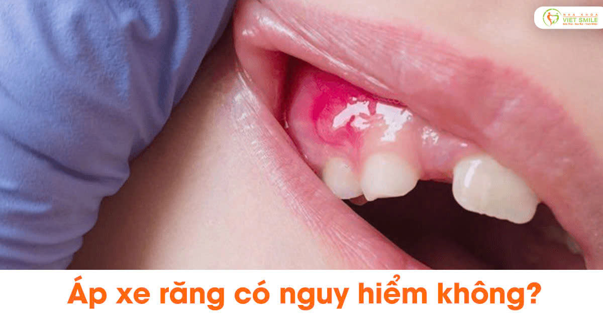 Áp xe răng có nguy hiểm không?