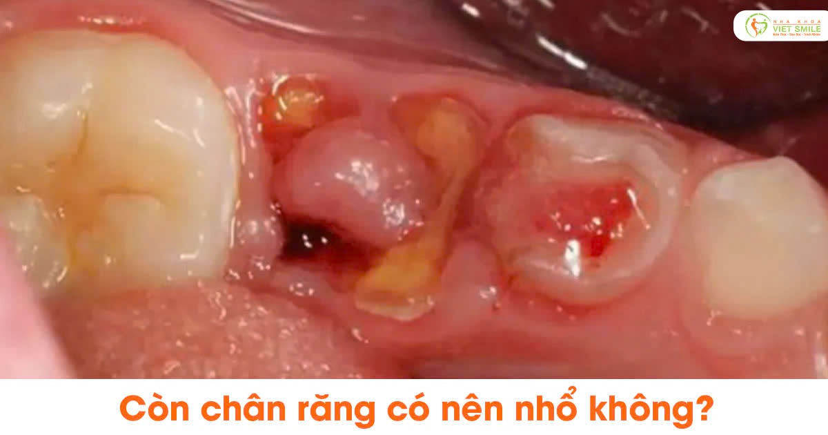 Còn chân răng có nên nhổ không?