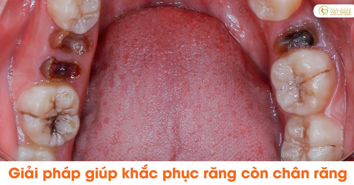 Giải pháp giúp khắc phục răng còn chân răng