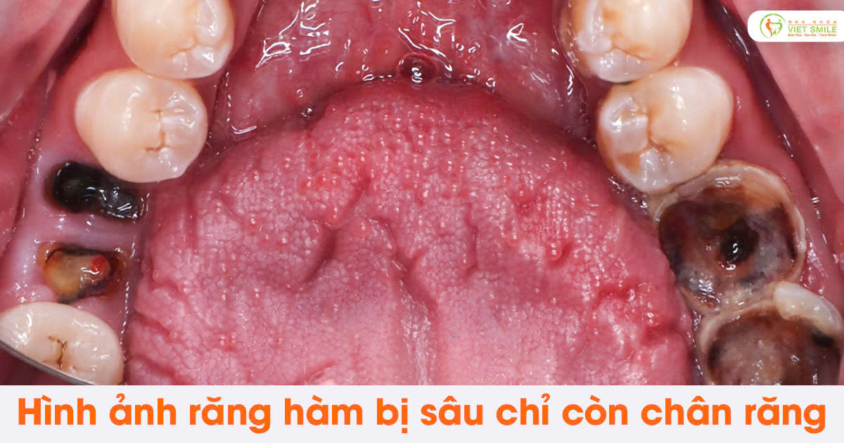 Hình ảnh răng hàm bị sâu chỉ còn chân răng