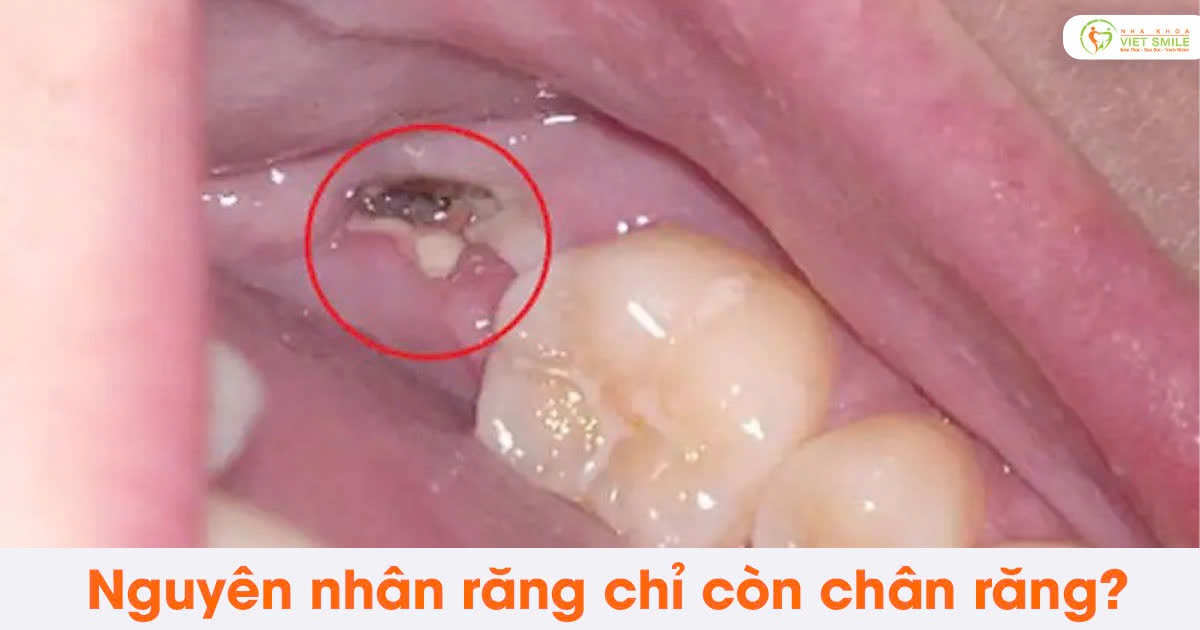 Nguyên nhân răng chỉ còn chân răng?