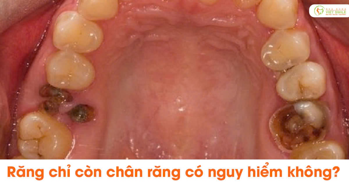 Răng chỉ còn chân răng có nguy hiểm không?