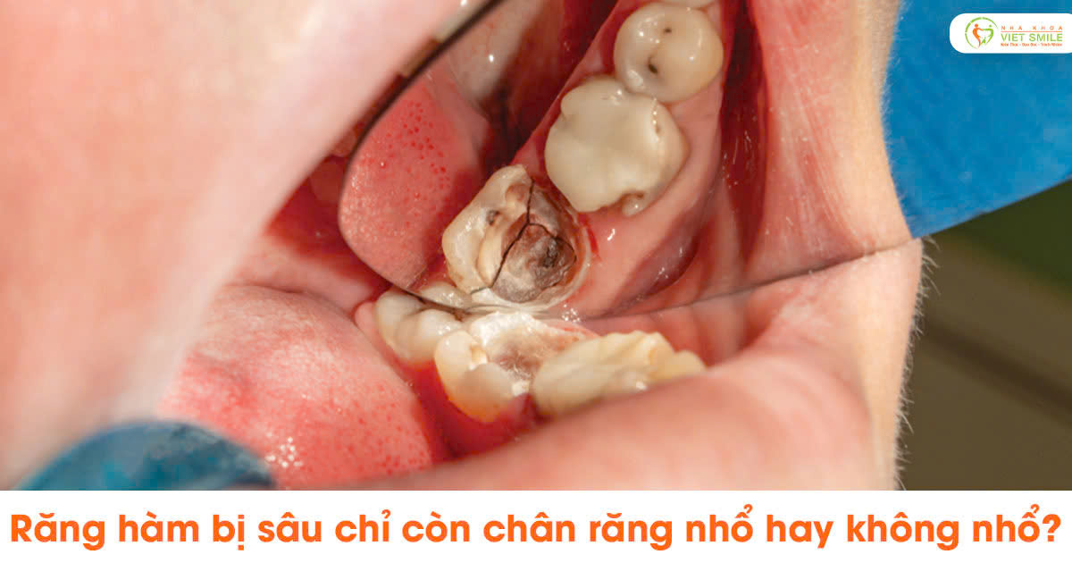 Răng hàm bị sâu chỉ còn chân răng nhổ hay không nhổ?