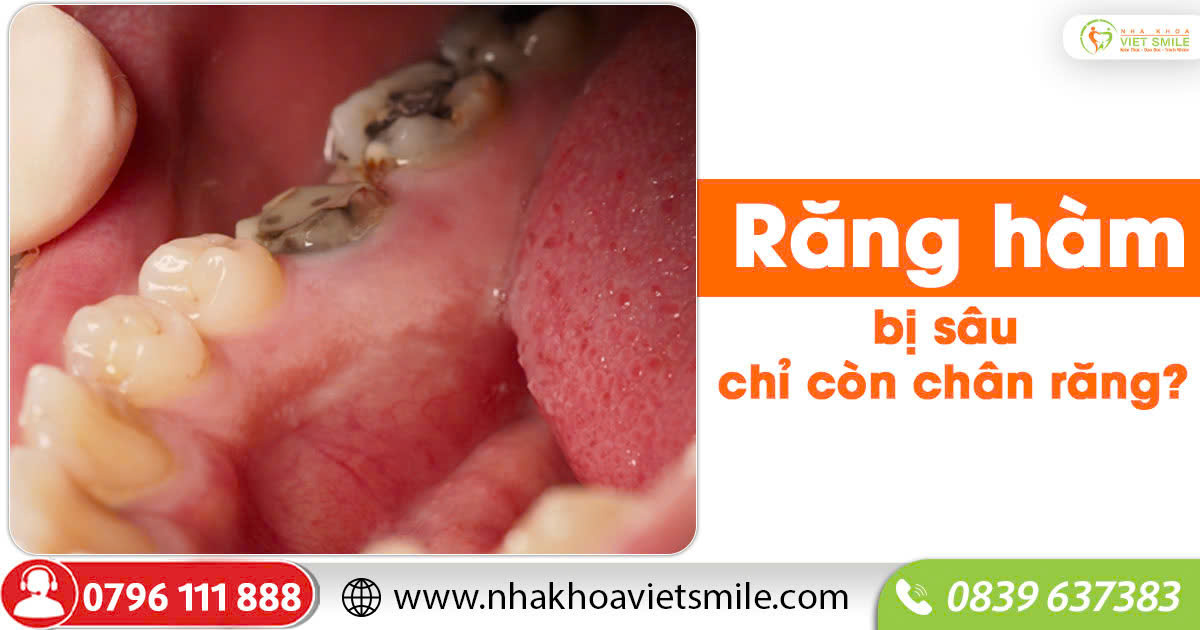 Răng hàm bị sâu chỉ còn chân răng?