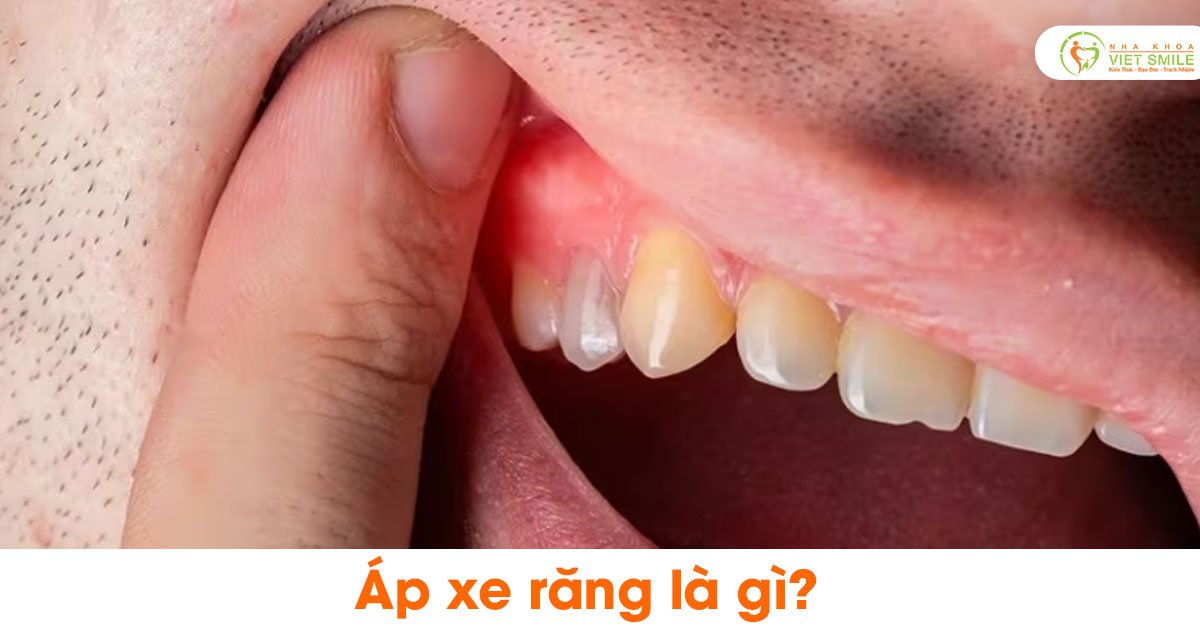 Áp xe răng là gì?