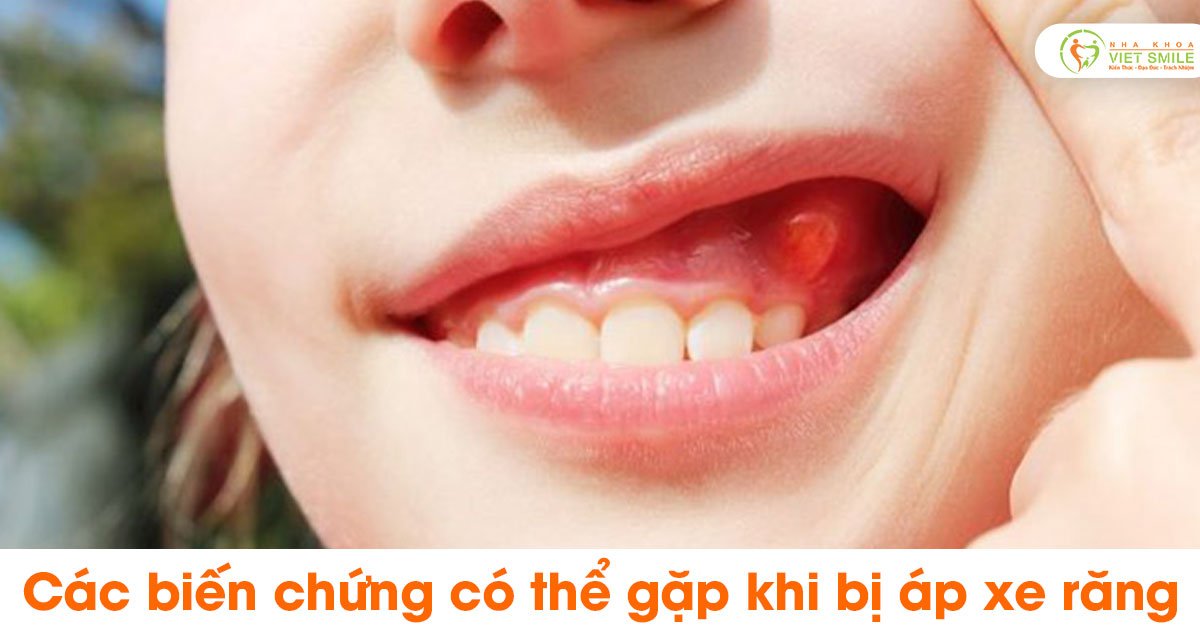 Các biến chứng có thể gặp khi bị áp xe răng