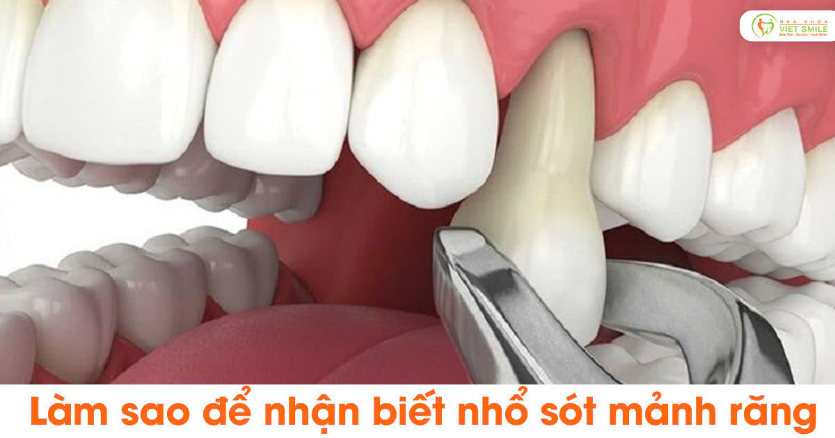 Làm sao để nhận biết nhổ sót mảnh răng