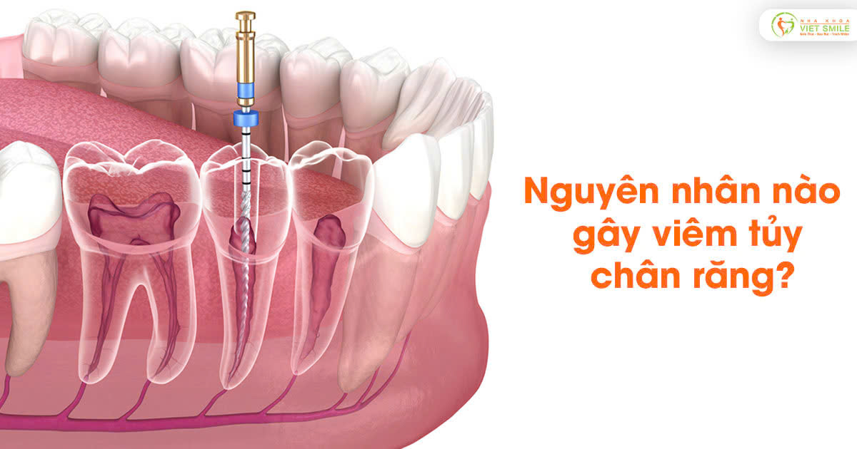 Nguyên nhân nào gây viêm tủy chân răng?