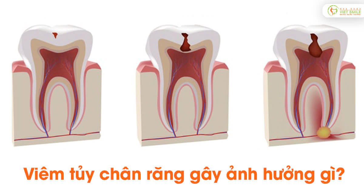 Viêm tủy chân răng gây ảnh hưởng gì?