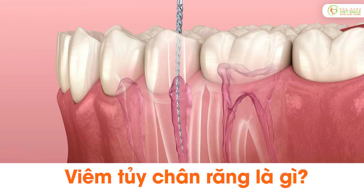 Viêm tủy chân răng là gì?