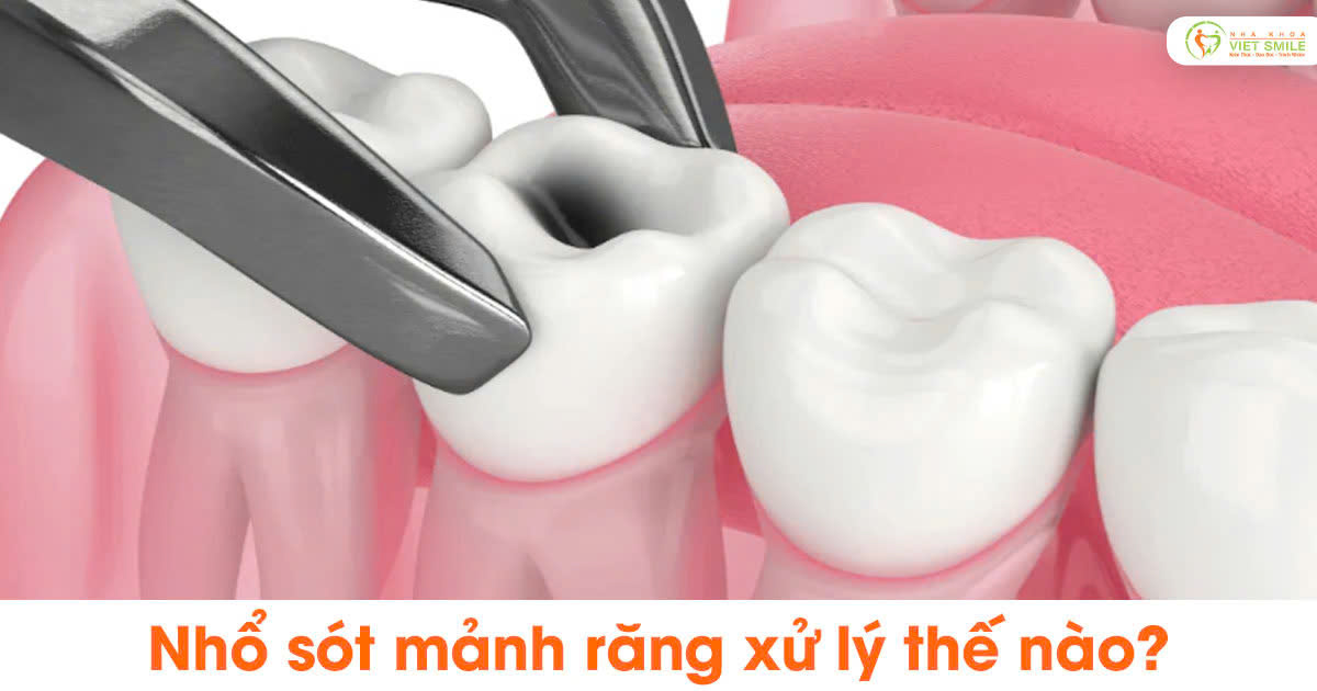 Nhổ sót mảnh răng xử lý thế nào?