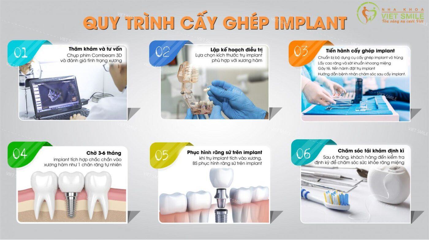 Cay ghep implant uy tin