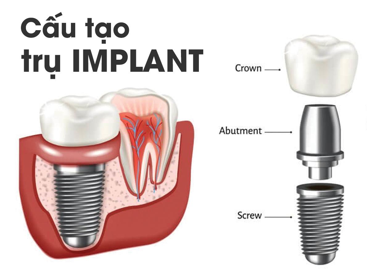 Cấu tạo răng implant