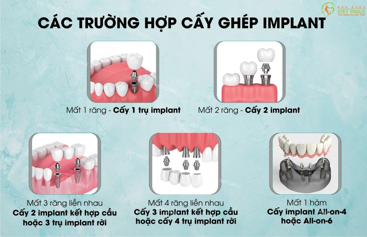 chi phí cấy ghép răng implant bao nhiêu? 3 Các trường hợp cấy ghép implant