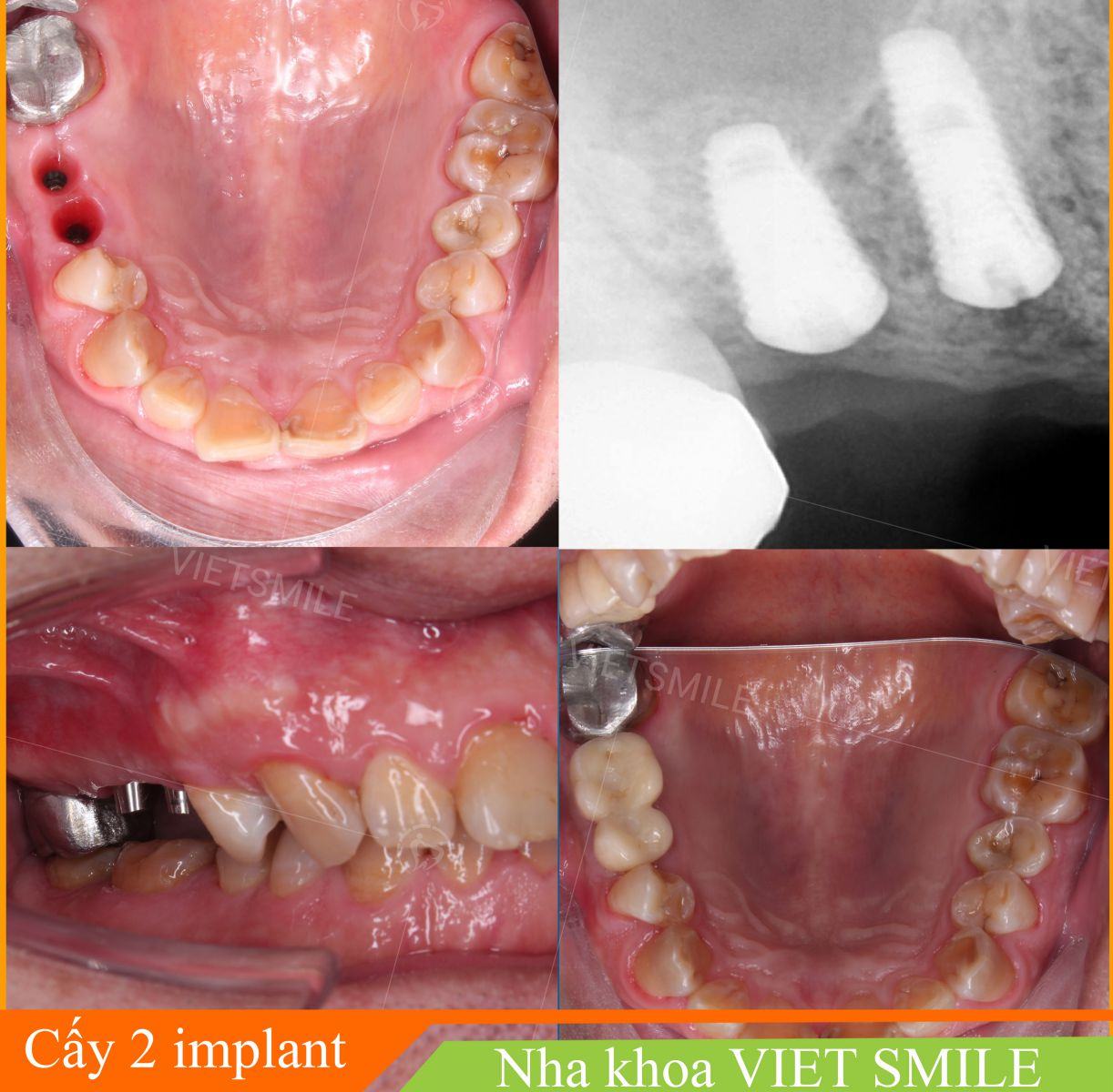 Cay ghep implant rang 6, 7