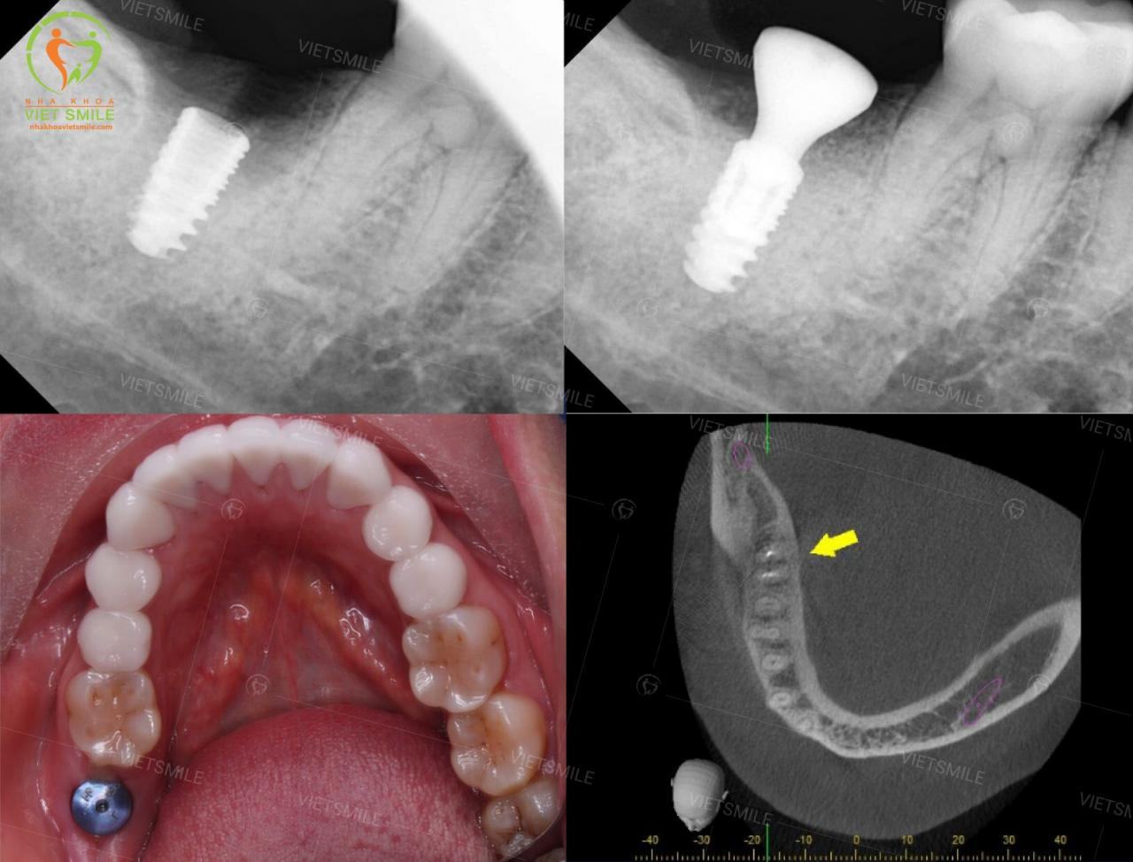 Chi phi cay ghep implant