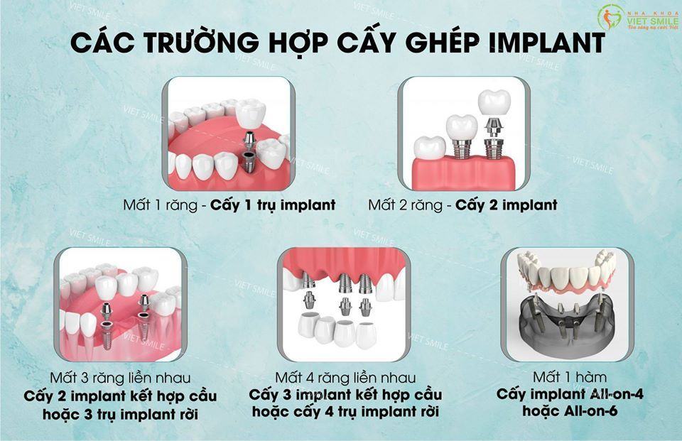 5 bước trong quy trình trồng răng implant chuẩn 3 Cấy ghép răng implant