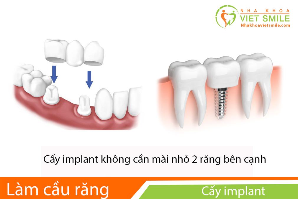 Cay ghep implant răng 7