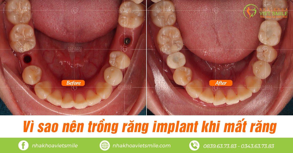 Kết quả trồng răng implant an toàn