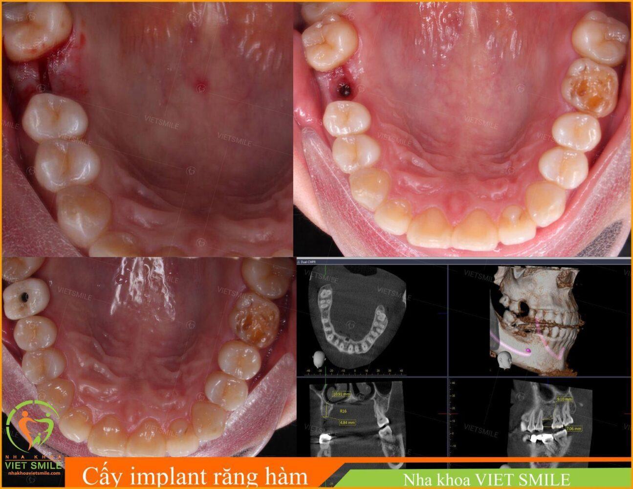 Cay ghep implant