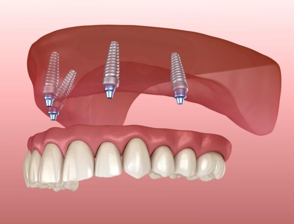 ưu điểm của trồng răng implant toàn hàm 2 Trồng răng all-on-4 cho người mất răng