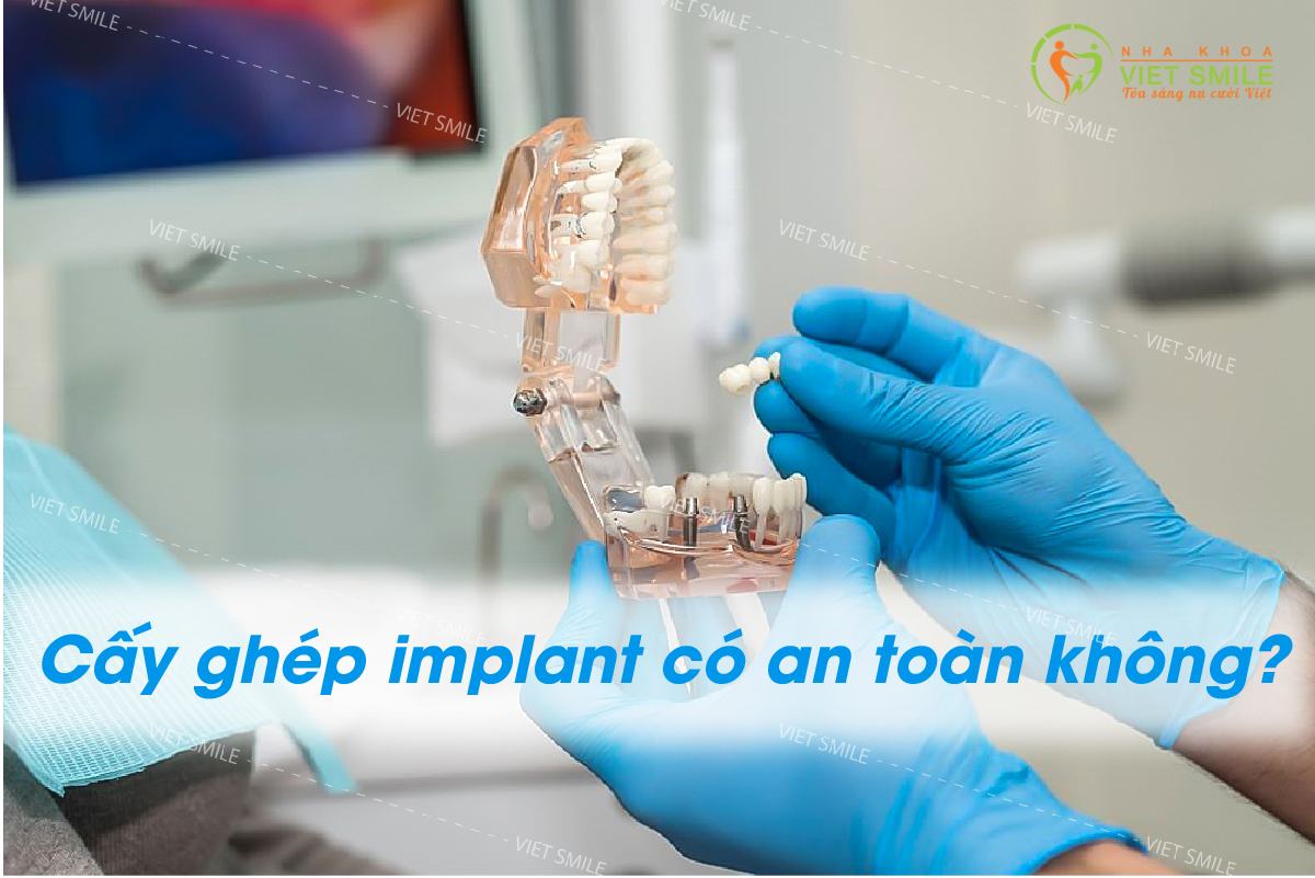 Vietsmile cay ghep implant co an toan khong.