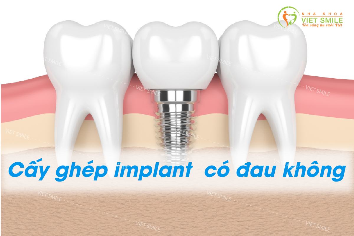 Trồng răng implant có đau không?