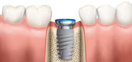 thời gian để hoàn thành 1 ca cắm implant 2 Dat tru implant