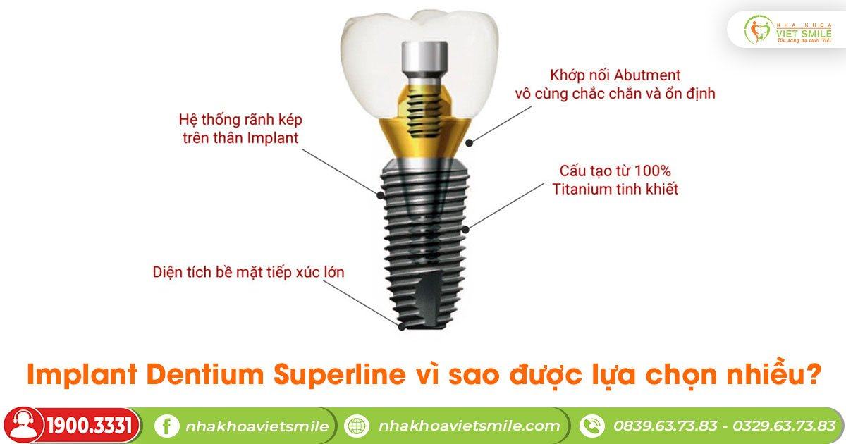 Implant dentium superline vì sao được lựa chọn nhiều?
