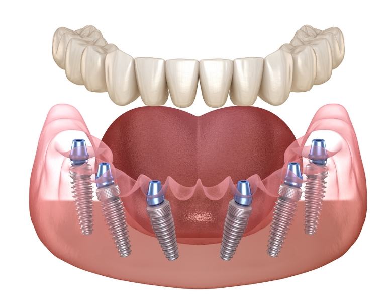 ưu điểm của trồng răng implant toàn hàm 3 Trồng răng all-on-6 khi mất răng toàn hàm