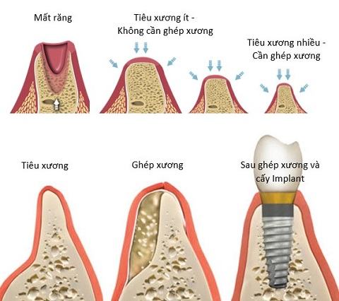 thời gian để hoàn thành 1 ca cắm implant 3 Tai sinh xuong