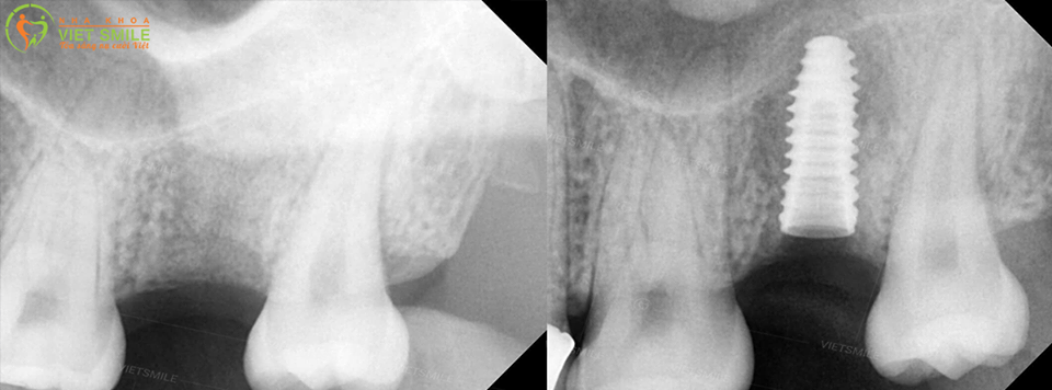 Giải đáp thắc mắc "trồng răng implant có đau không? "