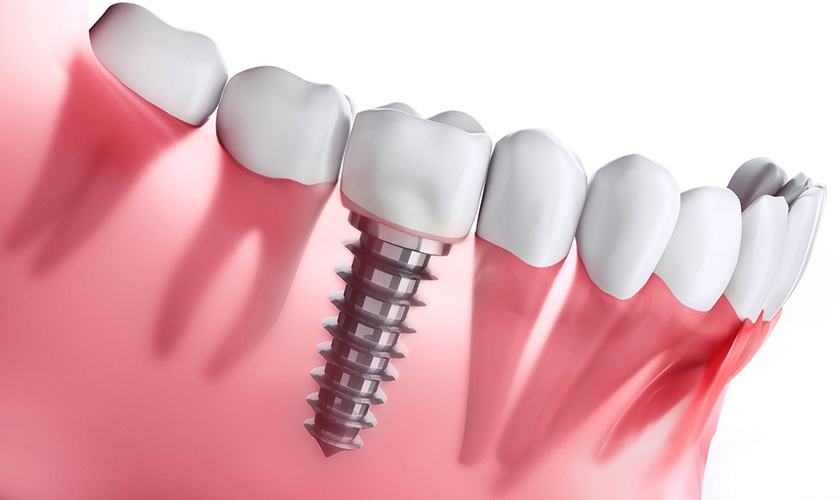 ưu điểm của trồng răng implant toàn hàm 1 Ưu điểm của trồng răng implant toàn hàm